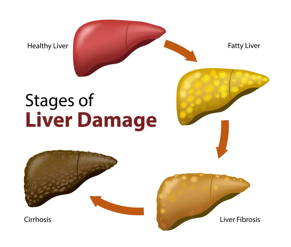 Liver damage from alcohol